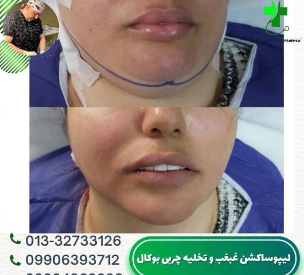 عکس های قبل و بعد از عمل غبغب