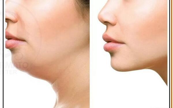 عکس های قبل و بعد از عمل غبغب