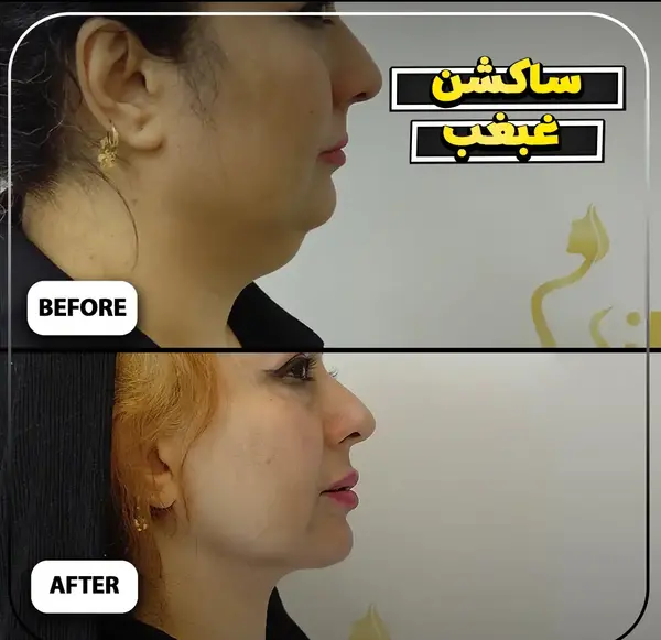 عکس های قبل و بعد از عمل غبغب