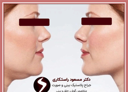 عکس های قبل و بعد از عمل غبغب