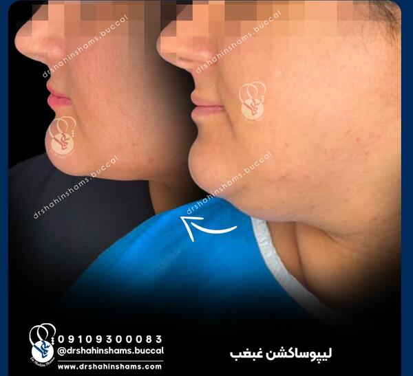 عکس های قبل و بعد از عمل غبغب
