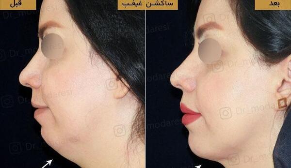 عکس های قبل و بعد از عمل غبغب