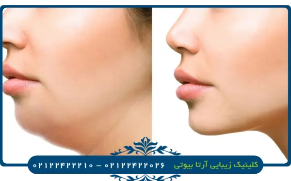 عکس های قبل و بعد از عمل غبغب
