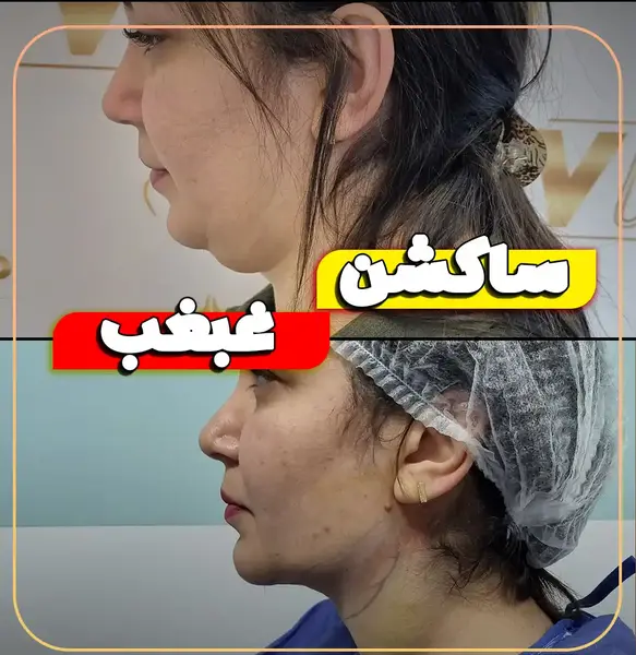 عکس های قبل و بعد از عمل غبغب