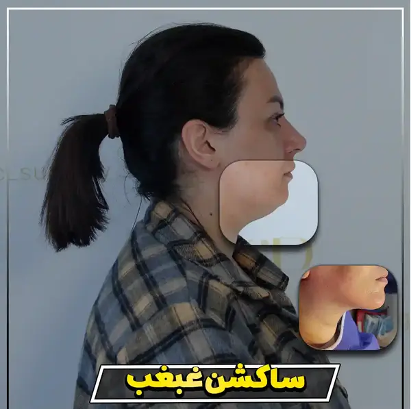عکس های قبل و بعد از عمل غبغب
