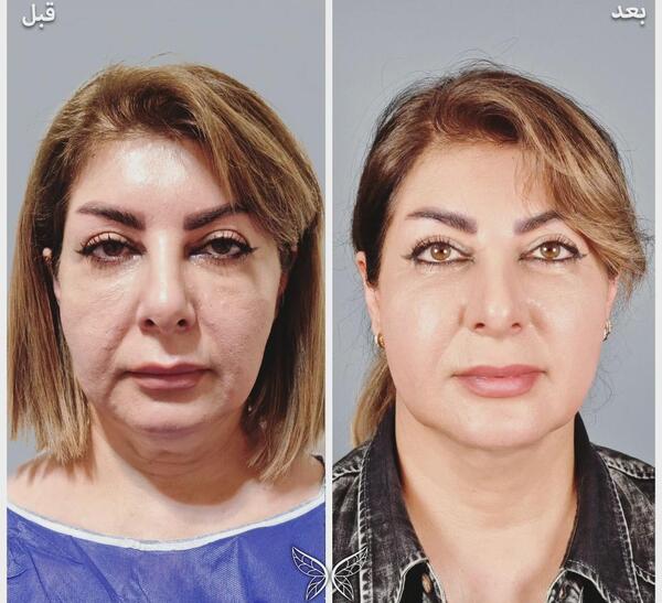 عکس قبل از عمل شکیب غلامی