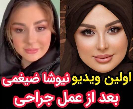 عکس قبل و بعد عمل بینی نیوشا ضیغمی