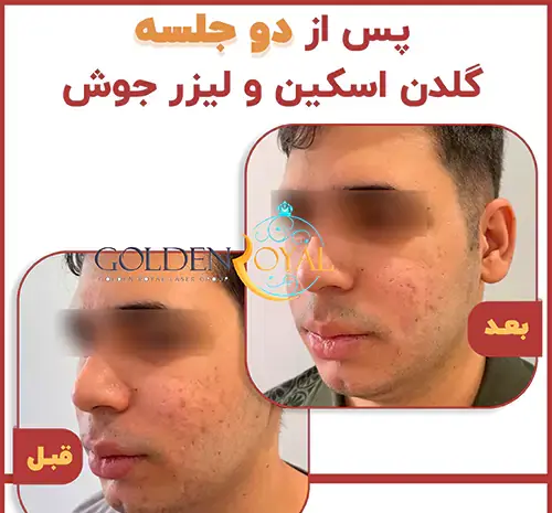 عکس قبل و بعد صورت جوش دار