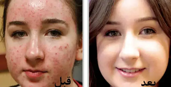 عکس قبل و بعد صورت جوش دار