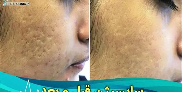 عکس قبل و بعد صورت جوش دار