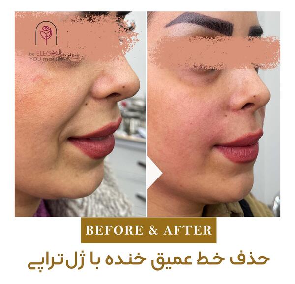 عکس قبل و بعد فیلر صورت