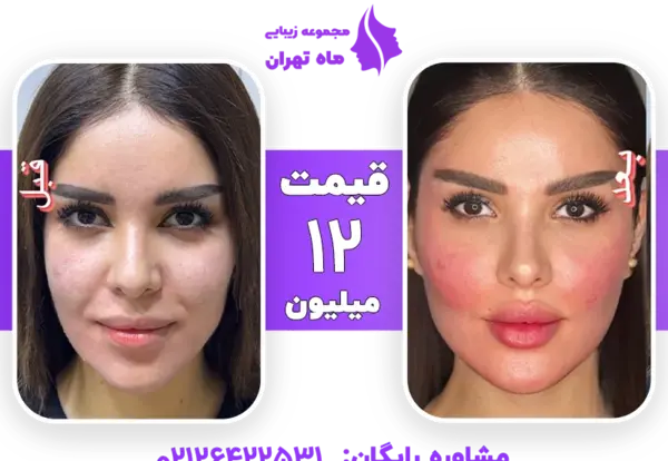 عکس قبل و بعد فیلر صورت