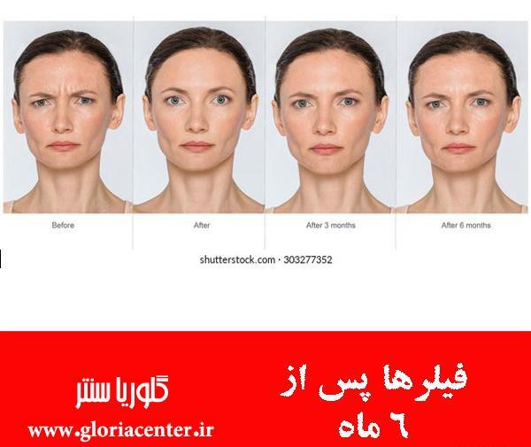 عکس قبل و بعد فیلر صورت