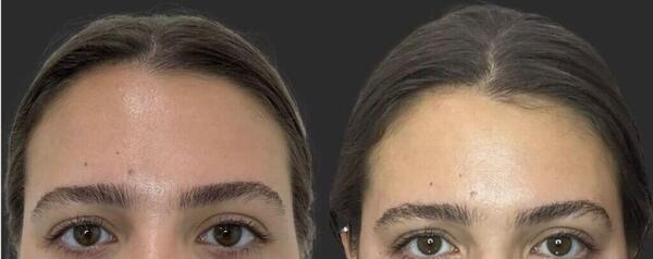 عکس قبل و بعد فیلر صورت
