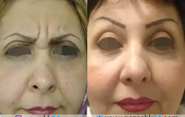 عکس قبل و بعد لیفت صورت