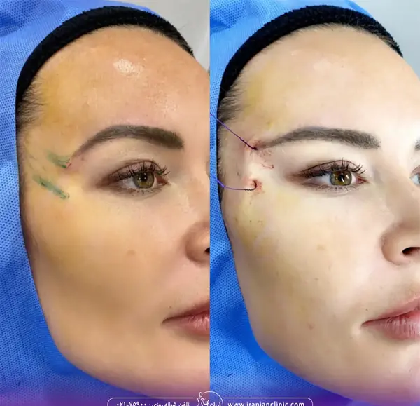 عکس قبل و بعد لیفت صورت