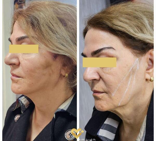 عکس قبل و بعد لیفت صورت