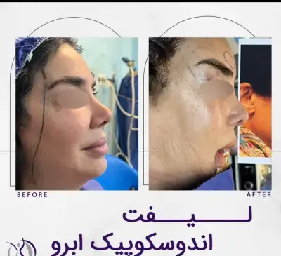 عکس قبل و بعد لیفت صورت