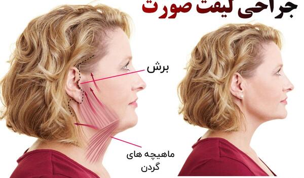 عکس قبل و بعد لیفت صورت