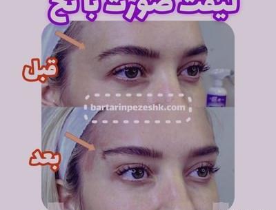 عکس قبل و بعد لیفت صورت