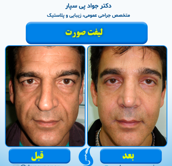 عکس قبل و بعد لیفت صورت