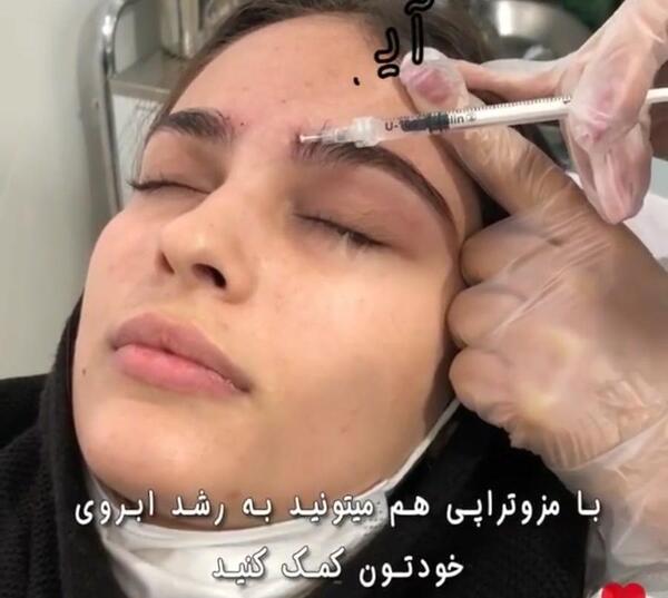 عکس قبل و بعد مزوتراپی صورت نی نی سایت