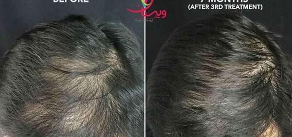 عکس قبل و بعد مزوتراپی صورت نی نی سایت