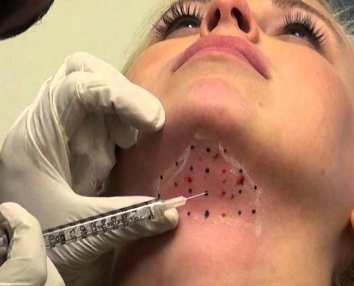 عکس قبل و بعد مزوتراپی صورت نی نی سایت