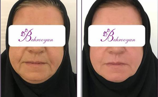 عکس قبل و بعد مزوتراپی صورت نی نی سایت