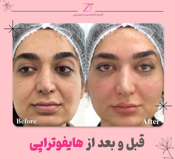 عکس قبل و بعد مزوتراپی صورت نی نی سایت