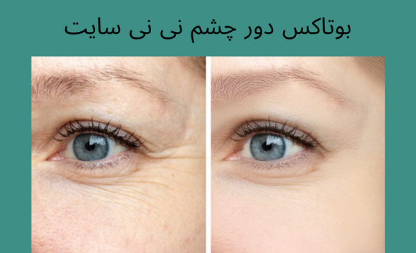 عکس قبل و بعد مزوتراپی صورت نی نی سایت