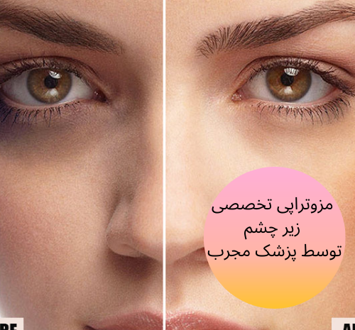 عکس قبل و بعد مزوتراپی صورت نی نی سایت