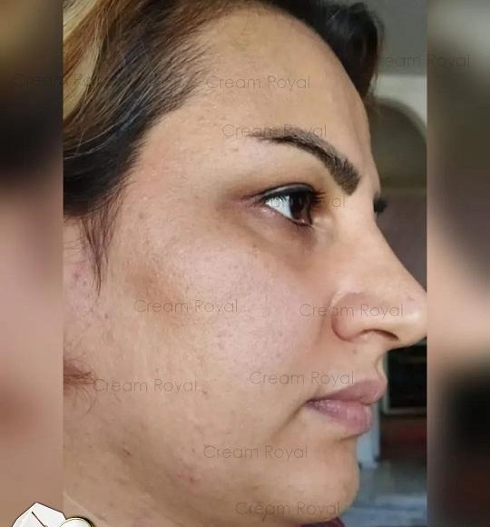 عکس قبل و بعد لک صورت