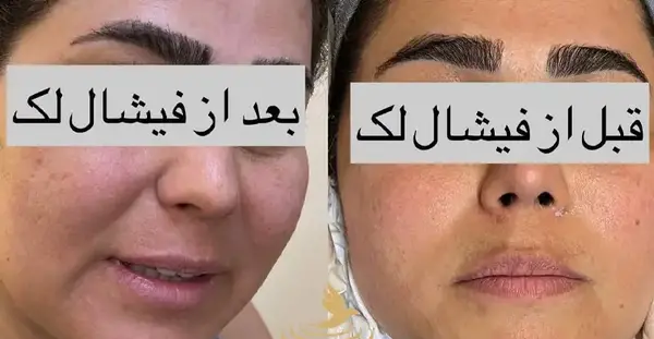 عکس قبل و بعد لک صورت