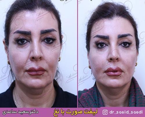 عکس قبل و بعد لیفت صورت با نخ