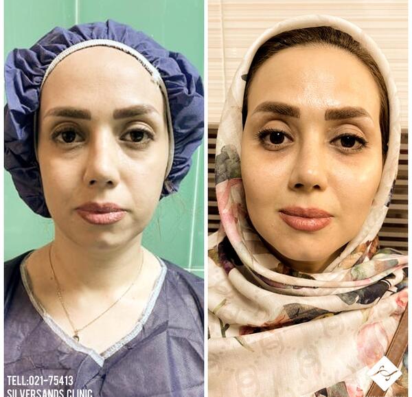 عکس قبل و بعد لیفت صورت با نخ