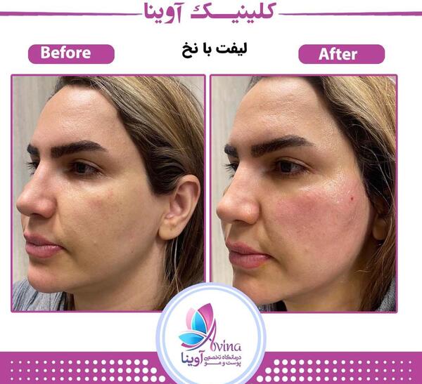 عکس قبل و بعد لیفت صورت با نخ