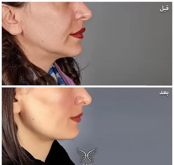 عکس قبل و بعد لیفت صورت با نخ