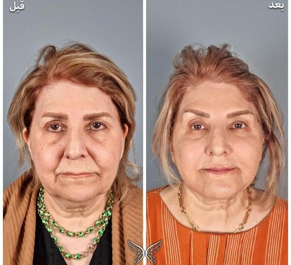 عکس قبل و بعد لیفت صورت با نخ