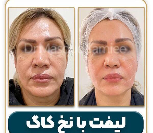 عکس قبل و بعد لیفت صورت با نخ
