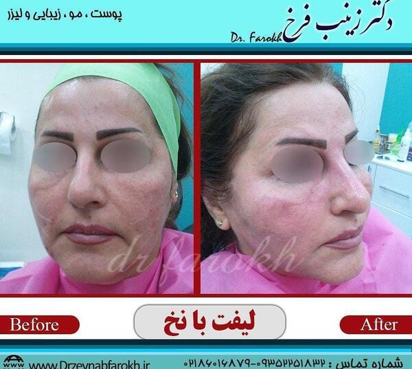 عکس قبل و بعد لیفت صورت با نخ