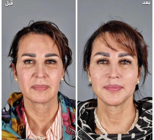 عکس قبل و بعد لیفت صورت با نخ