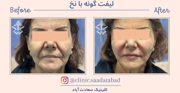عکس قبل و بعد لیفت صورت با نخ