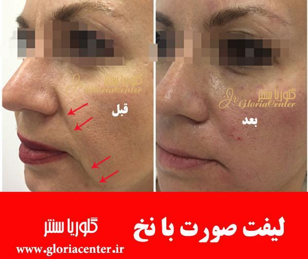 عکس قبل و بعد لیفت صورت با نخ