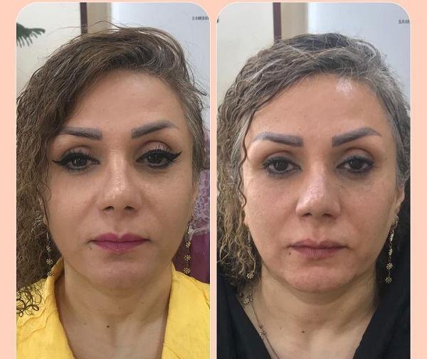 عکس قبل و بعد لیفت صورت با نخ