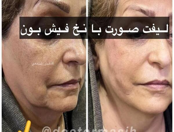 عکس قبل و بعد لیفت صورت با نخ