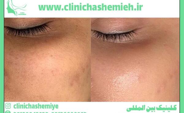 عکس قبل و بعد پاکسازی صورت در ارایشگاه