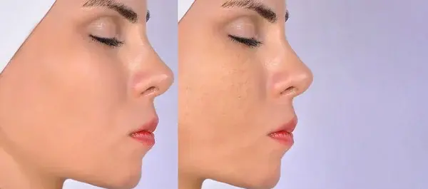 عکس قبل و بعد پاکسازی صورت در ارایشگاه