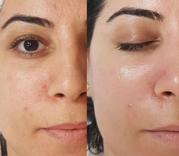 عکس قبل و بعد پاکسازی صورت در ارایشگاه