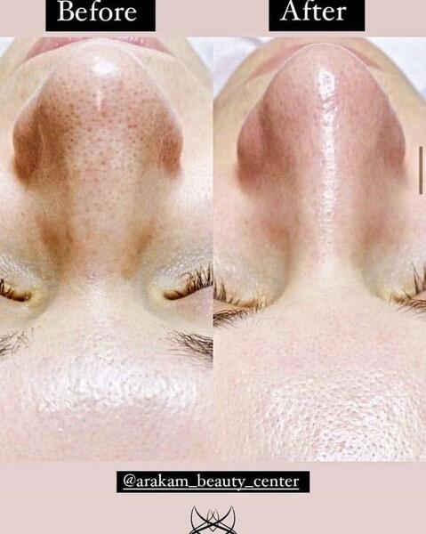 عکس قبل و بعد پاکسازی صورت در ارایشگاه